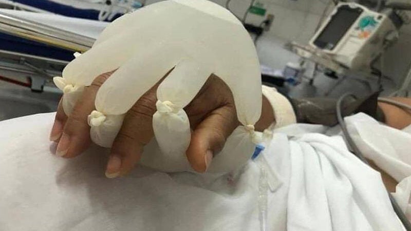 Diretor da OMS elogia técnica da mãozinha criada por enfermeira brasileira