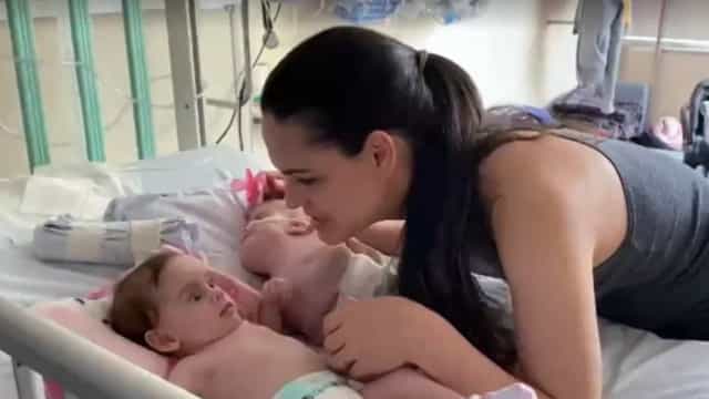 Siamesas unidas pelo tronco sobrevivem a cirurgia inédita no Brasil