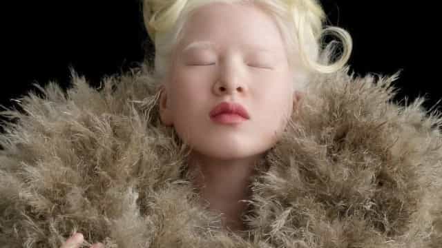 Abandonada quando nasceu por ser diferente, Xueli é agora modelo da Vogue