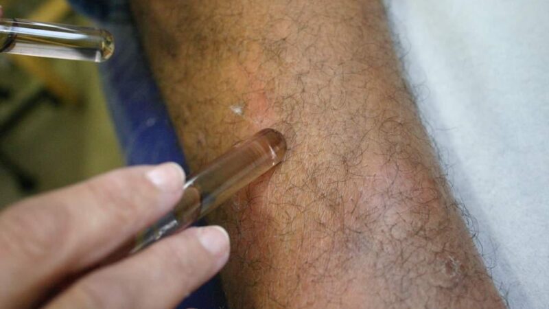 Inscrições para capacitação em hanseníase estão abertas