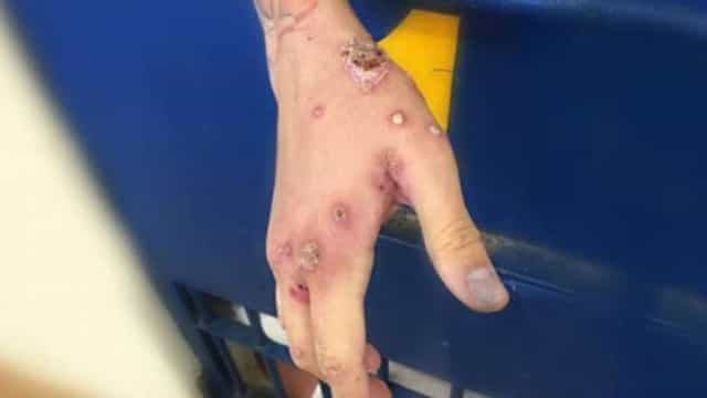 Sarna humana atinge moradores do litoral de SP