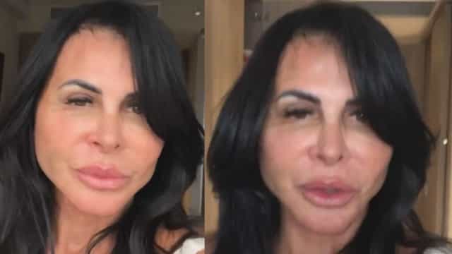 Gretchen exibe resultado de cirurgia plástica: "Sem filtro"