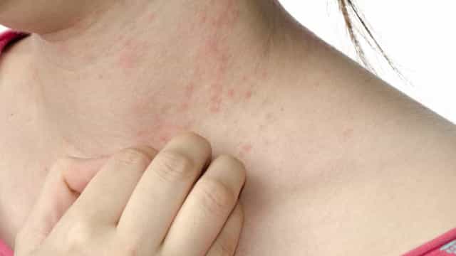 Casos de herpes zoster aumentam 35%