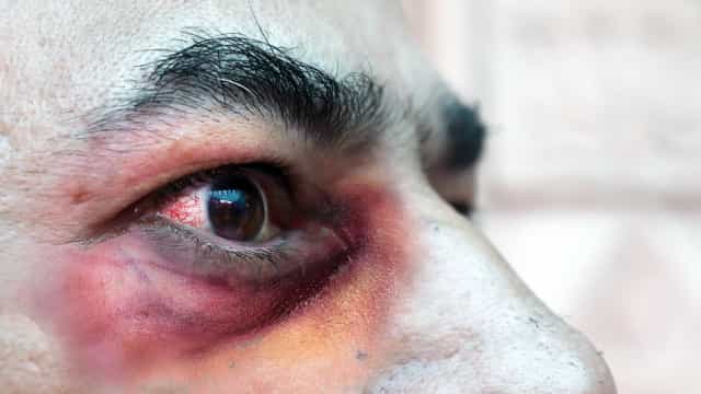 Novo caso suspeito de mucormicose é identificado em Mato Grosso do Sul