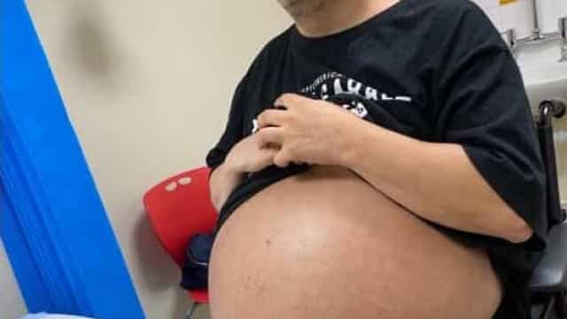 Homem se prepara para remover rins com tamanho recorde