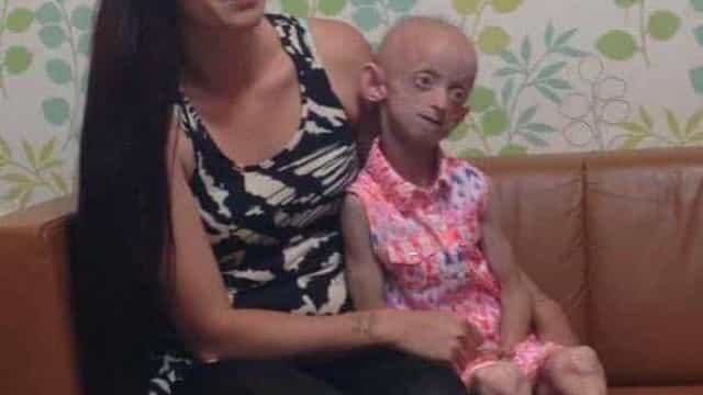 Morre jovem de 18 anos que aparentava ter mais de 100 anos