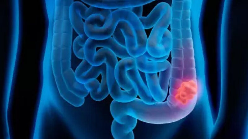 Cientista descobre maneira de detectar câncer de cólon precoce