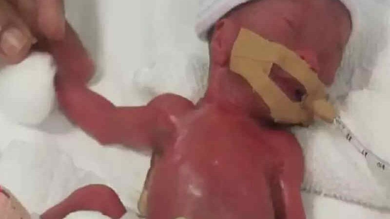 Menor bebê prematuro do mundo recebe alta após 13 meses na UTI