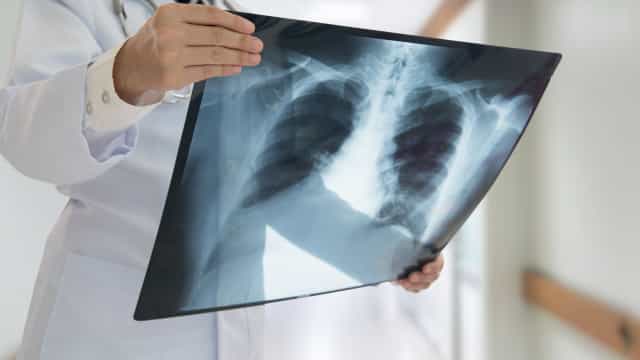 Transplante pulmonar salva doente no pós-covid