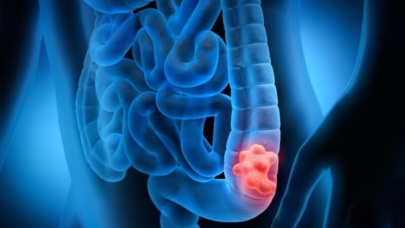 Câncer de intestino está entre os mais comuns para homens e mulheres