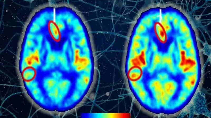 Alzheimer pode ser revertido com câmaras de oxigênio