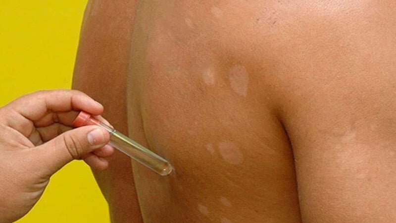 Fiocruz desenvolve teste molecular inédito para detectar hanseníase