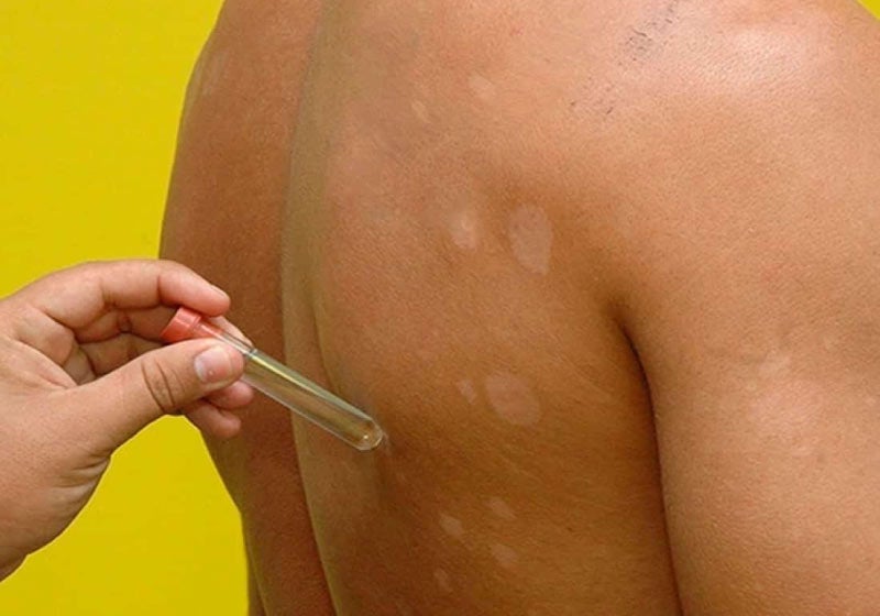 Fiocruz desenvolve teste molecular inédito para detectar hanseníase