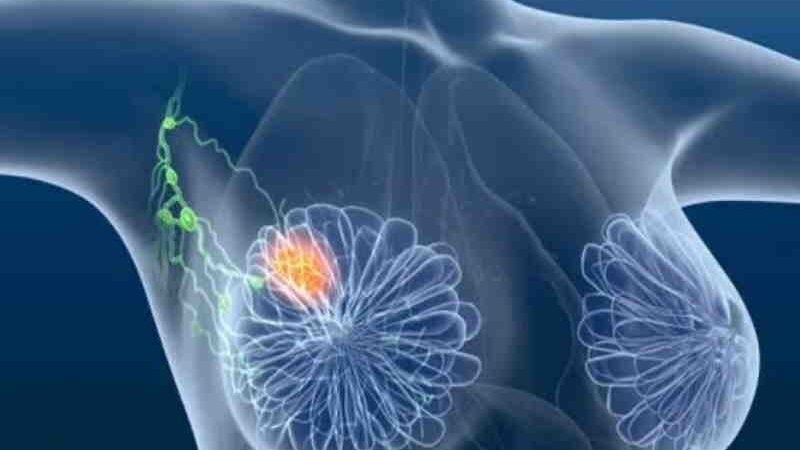 Médicos descobrem novo tratamento para câncer de mama agressivo