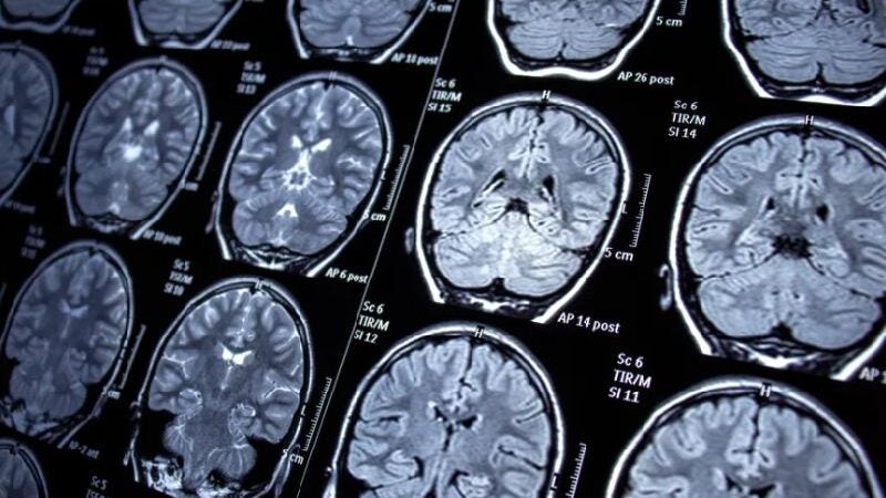 Depressão: paciente melhora após implante no cérebro