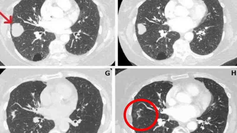 Tumor no pulmão de idosa reduz 76% após uso de canabidiol