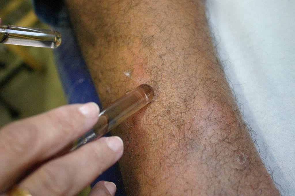 SES capacita Agentes Comunitários em Saúde sobre sinais e sintomas da hanseníase