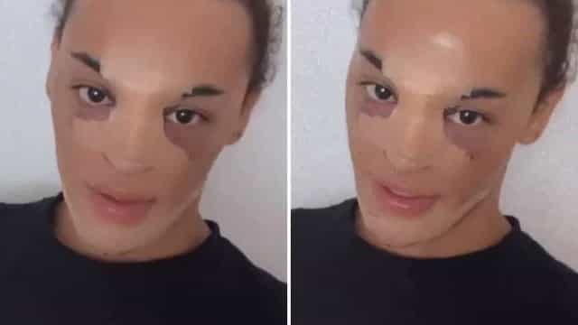 Pabllo Vittar publica foto após rinoplastia e diz adorar ‘intervençãozinha’