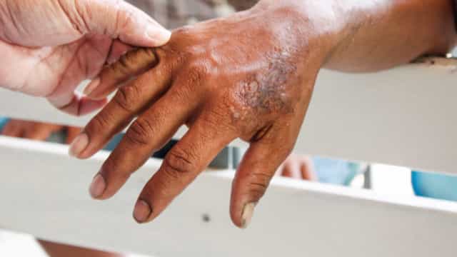 Novos casos de hanseníase caíram 35% na pandemia de Covid