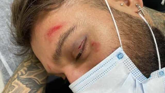 Lucas Lucco preocupa fãs após aparecer com o rosto machucado: ‘Bebi demais’