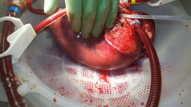 Número de doadores de órgãos volta a cair em 2021, diz associação