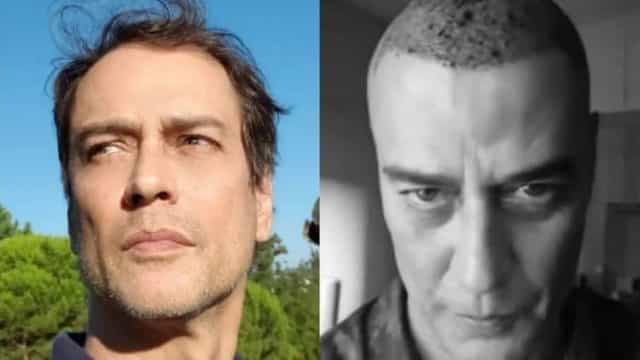 Marcello Antony mostra resultado de implante capilar