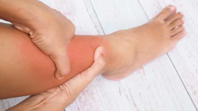 Inchaço em braços ou pernas pode ser linfedema; conheça a doença