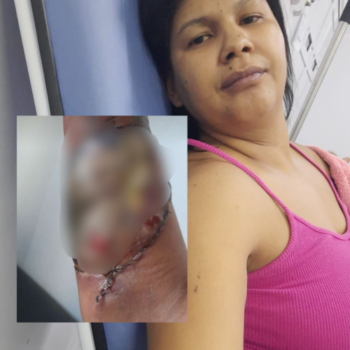 Em Guarantã do Norte mulher corre risco de perder o braço após ataque de Pitbull