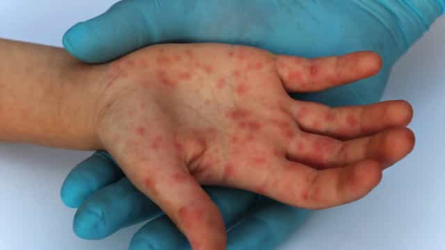 São Paulo registra caso de sarampo; Estado investiga 25 relatos