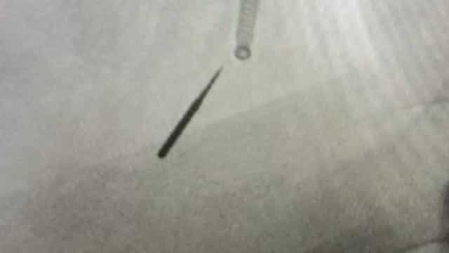 Homem ‘inala’ parte da broca durante consulta ao dentista no Ilinóis