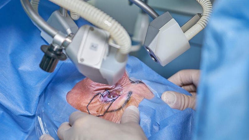 Novo tratamento revolucionário dispensa cirurgia de catarata