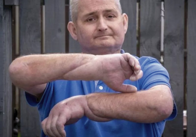Homem com doença rara recebe transplante de mãos inédito