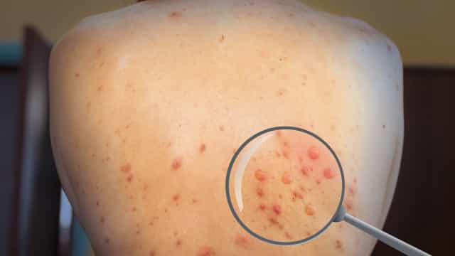 Total de casos de varíola dos macacos no Brasil sobe para 37