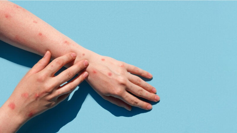 Varíola: Brasil registra primeira morte e MT tem dois casos suspeitos