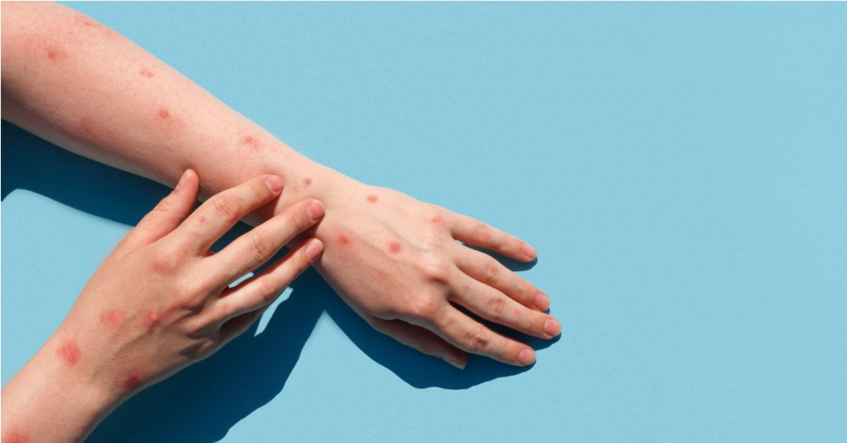 Varíola: Brasil registra primeira morte e MT tem dois casos suspeitos