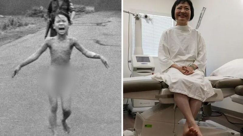 Menina queimada na Guerra do Vietnã em 72 faz último tratamento de pele