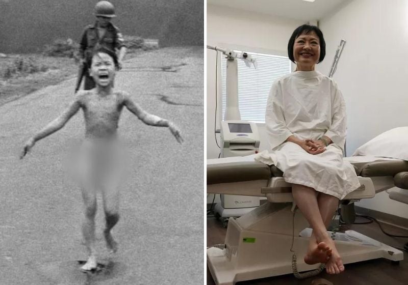 Menina queimada na Guerra do Vietnã em 72 faz último tratamento de pele