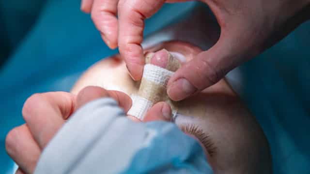 Homem é hospitalizado após tentar a viral "rinoplastia caseira"