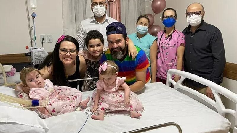 Gêmeas siamesas separadas em SP passam bem. Cirurgia teve ajuda de modelagem 3D