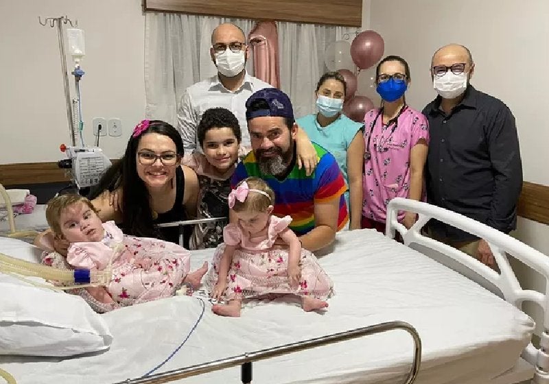 Gêmeas siamesas separadas em SP passam bem. Cirurgia teve ajuda de modelagem 3D