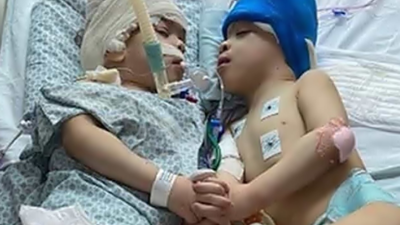 Gêmeos siameses unidos pela cabeça são separados em cirurgia inédita no SUS