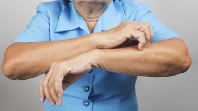 Pacientes com doenças de pele crônicas enfrentam estigma na vida profissional