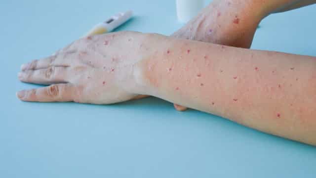 Aumento de casos de varíola dos macacos começa a sobrecarregar laboratórios