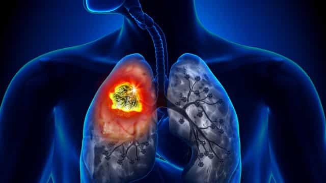 Estudo indica para SUS radioterapia que trata câncer de pulmão em até 5 sessões
