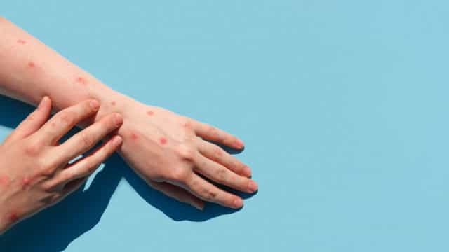 Varíola dos macacos: Américas são epicentro global, com mais de 30 mil casos