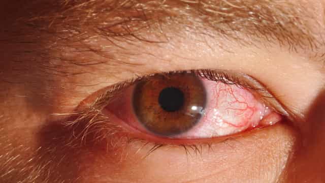 Fim das restrições da pandemia contribui para aumento dos casos de conjuntivite