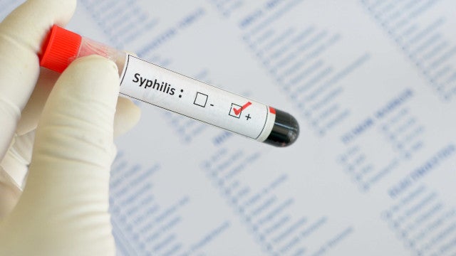 Caso de sífilis de 10 mil anos atrás é descoberto no interior de MG