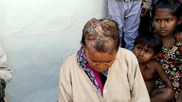 Mulher com doença rara desenvolve ‘chifres’ na cabeça: "Dor insuportável"