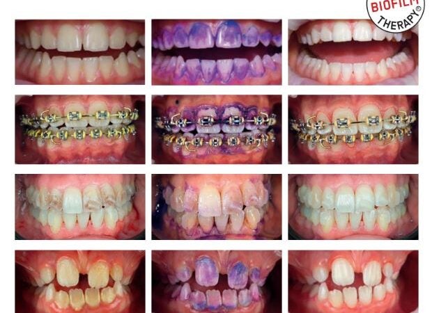 Conheça o procedimento dental minimamente invasivo com menos dor e mais conforto para os pacientes