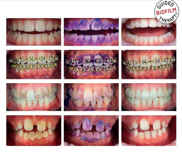 Conheça o procedimento dental minimamente invasivo com menos dor e mais conforto para os pacientes